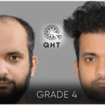 Understanding Hair Transplant Costs: What You Need to Know