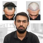 Top PRP Clinics for Hair Regrowth in Hyderabad
