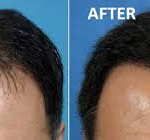 PRP Hair Restoration Therapy in Hyderabad: A Regenerative Approach to Hair Loss