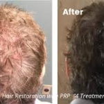 Complete Guide to Hair Transplant in Hyderabad: What to Expect