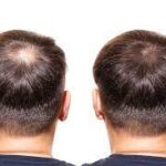 Facial Hair Restoration in Hyderabad: A Comprehensive Guide