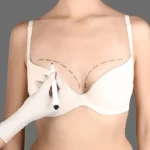 Preparing for the Best Breast Augmentation Surgery Experience