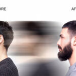 Who Can Get a Beard Transplant? Age, Genetics & More