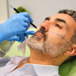 Beard Transplant Before and After: Real Results from Real Men