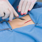 Best Breast Reduction Surgery Scarring: How to Minimize