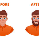 Who is a Suitable Candidate for Beard Transplant?