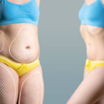 Liposuction Surgery Costs in 2025: What You Should Budget