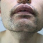 Beard Transplant Before and After Photos