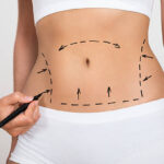 Combining Liposuction with Skin Tightening: Best Procedures 2025
