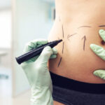 Is Liposuction Safe? 2025 Safety Tips from Experts