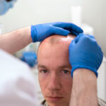 Hair Transplant in India – Everything International Patients Need to Know