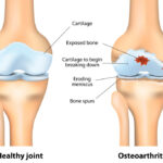DJD ICD 10: A Complete Guide to Degenerative Joint Disease Coding