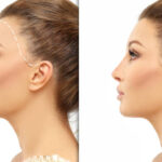 Questions to Ask During Your Hair Transplant Consultation