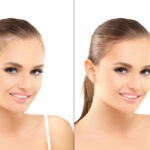 Combining PRP Therapy with Hair Transplants for Enhanced Results